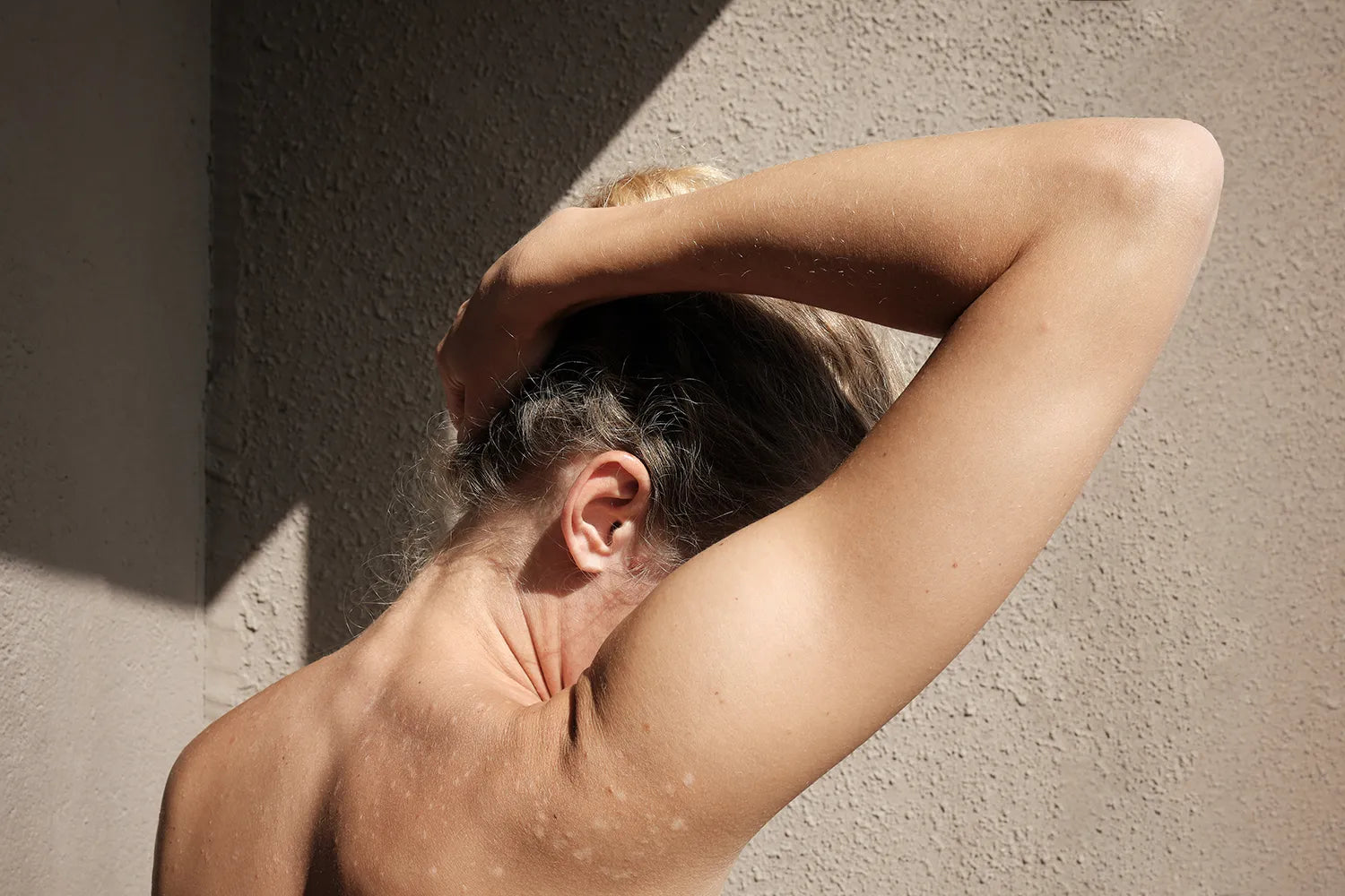 Psoriasis: Qué es, síntomas y tratamientos para esta enfermedad crónica de la piel