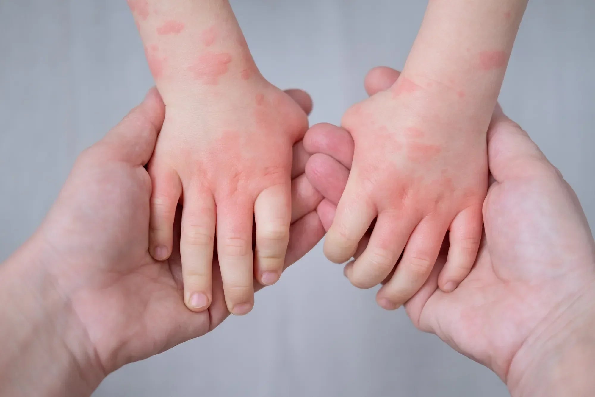 Dermatitis en bebés: Síntomas y cómo tratarlos