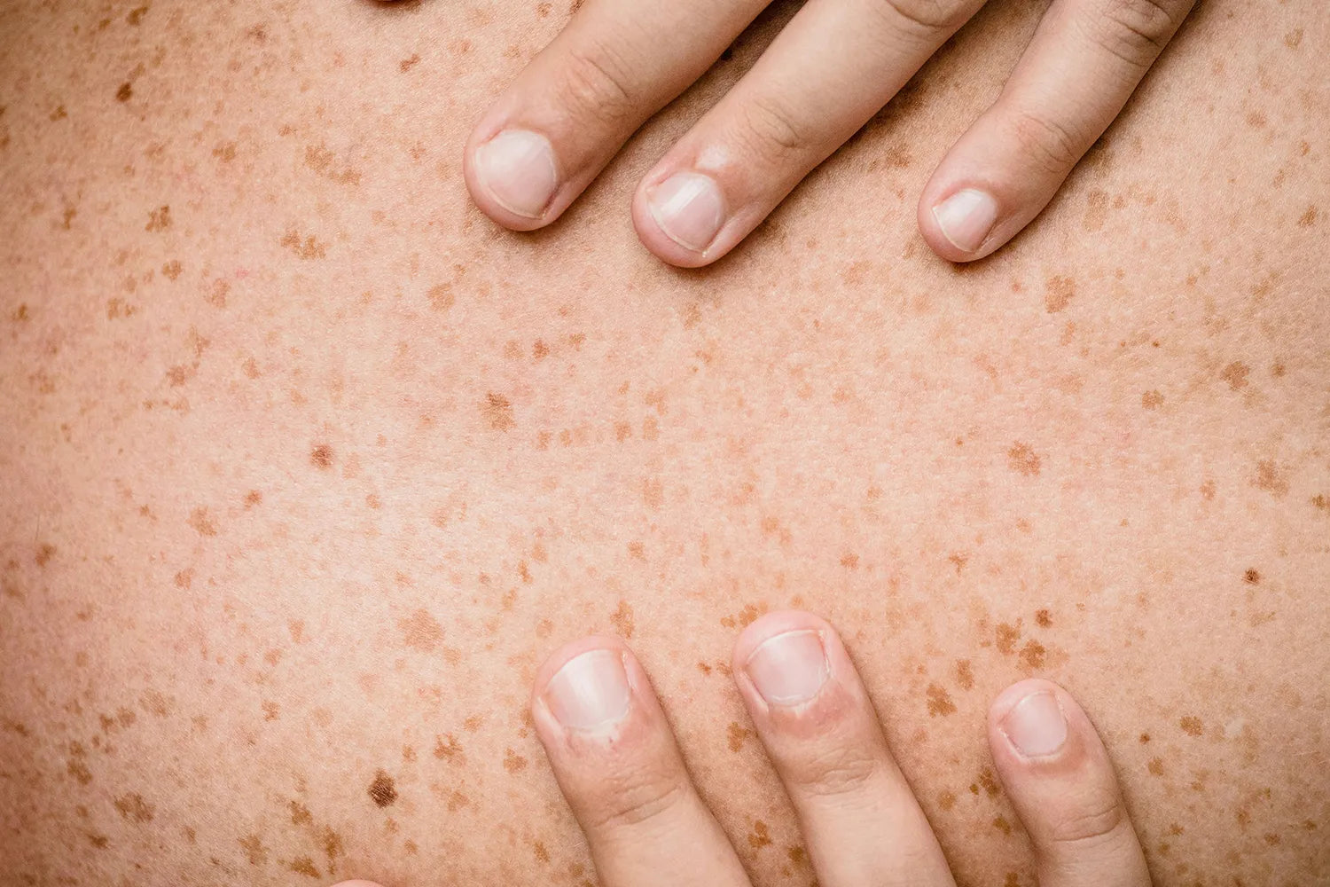 CBD y microbiota cutánea: una piel más equilibrada y resistente de forma natural