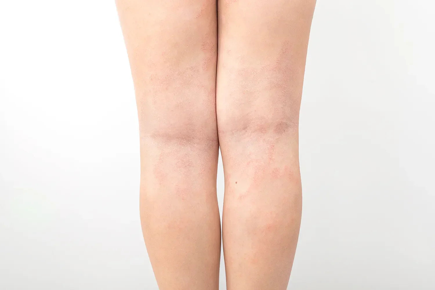 Tratamientos naturales para la psoriasis: Opciones alternativas para aliviar los síntomas