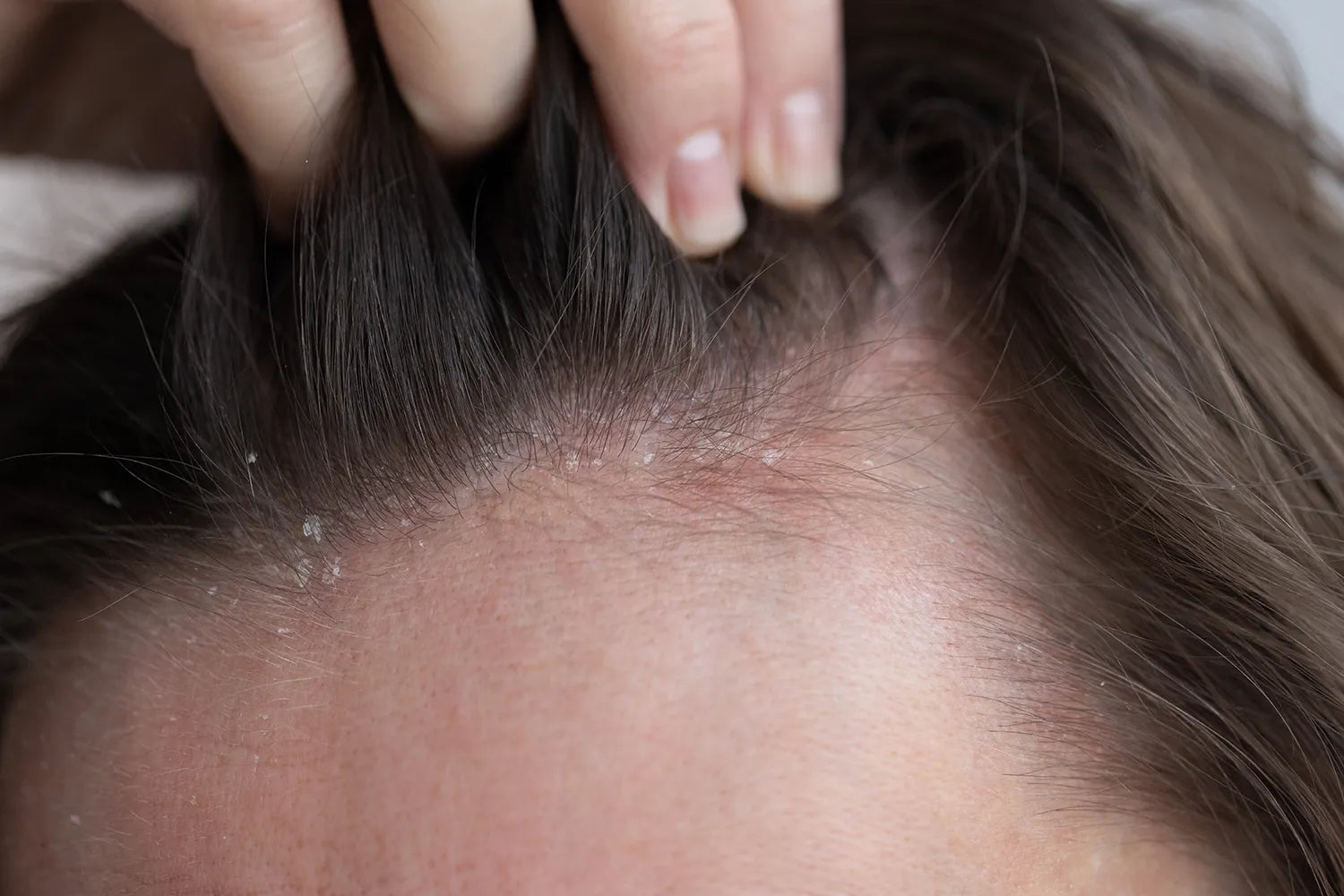 Psoriasis y dermatitis seborreica: Cómo diferenciarlas y cual es su tratamiento