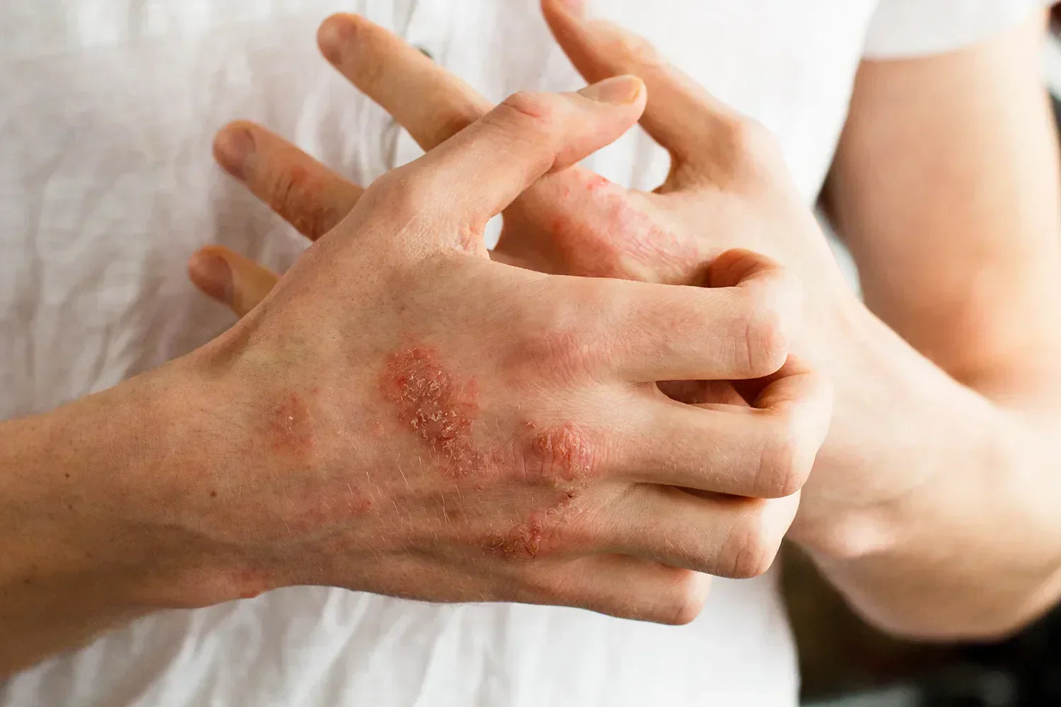 CBD para la dermatitis: Alivio natural para los síntomas inflamatorios