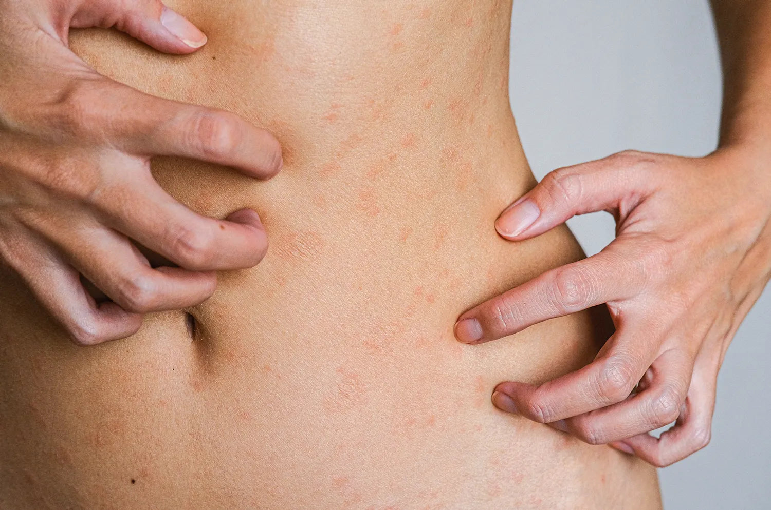 CBD para el eccema: Un aliado natural para calmar la piel irritada