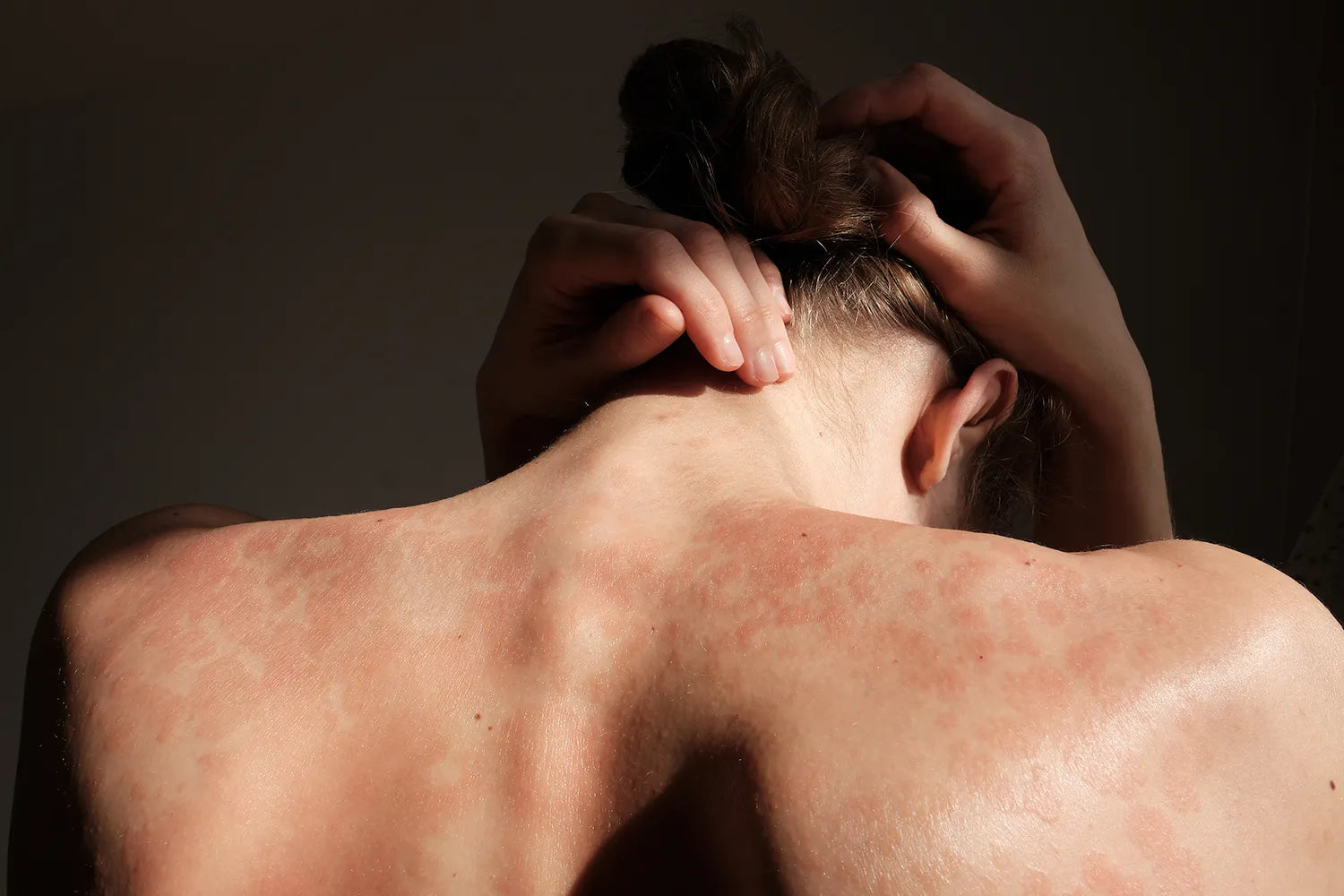 CBD para la psoriasis: ¿cómo puede aliviar los síntomas?